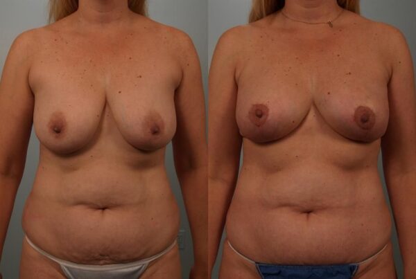 Breast Lift (Mastopexy) 18