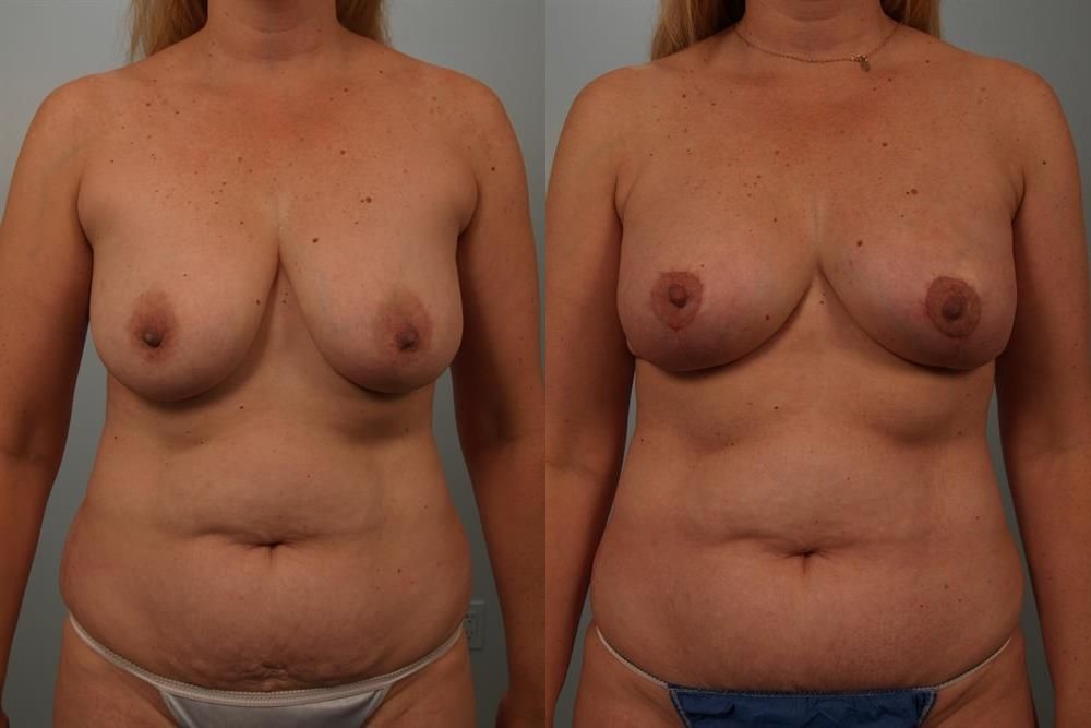 Breast Lift (Mastopexy) 18