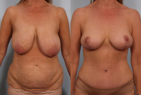 Breast Lift (Mastopexy) 19
