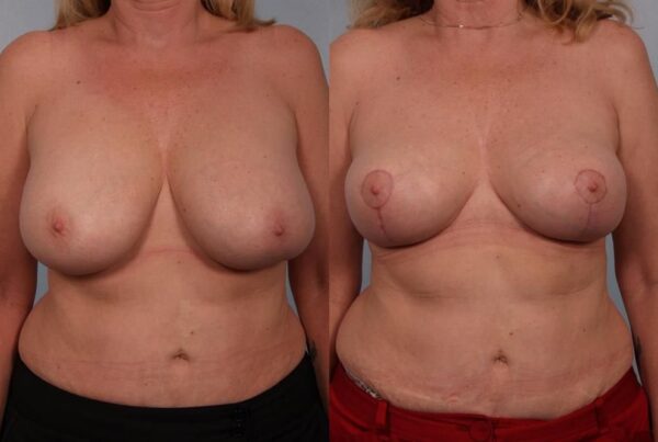 Breast Lift (Mastopexy) 2