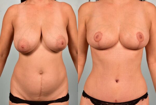 Breast Lift (Mastopexy) 20