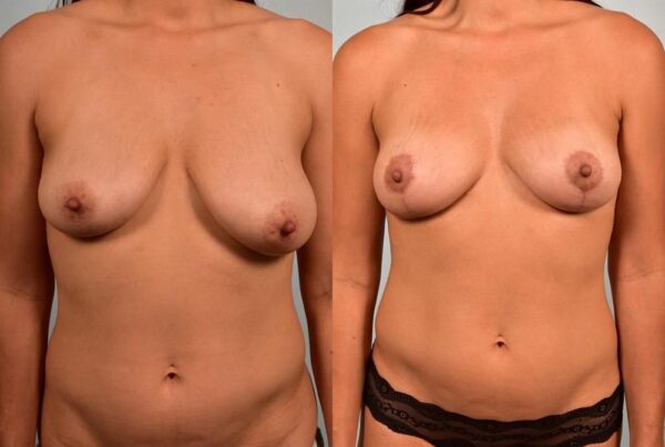 Breast Lift (Mastopexy) 21