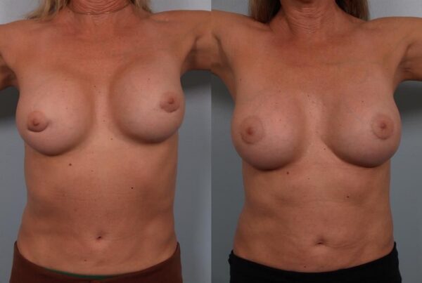 Breast Lift (Mastopexy) 22