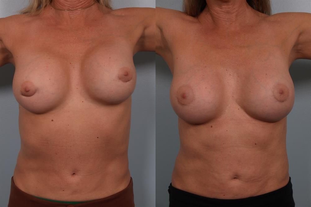 Breast Lift (Mastopexy) 22