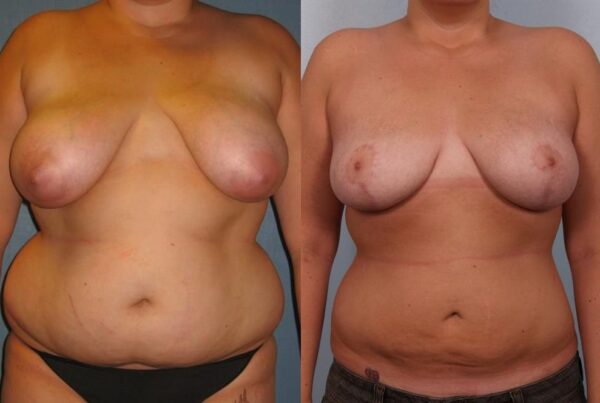 Breast Lift (Mastopexy) 23