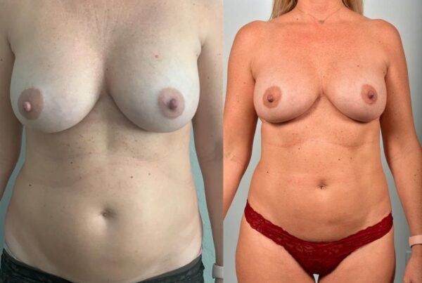 Breast Lift (Mastopexy) 24