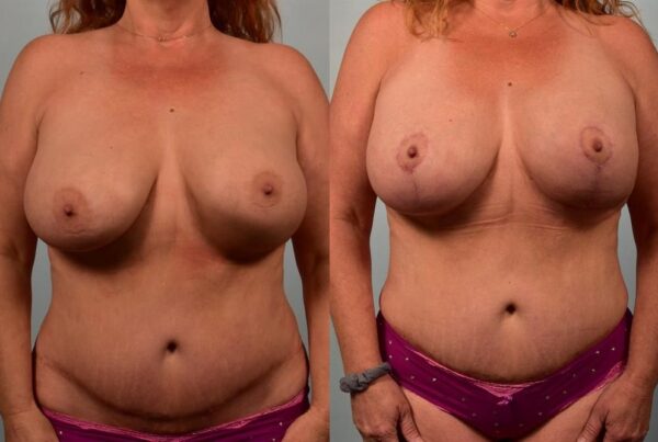 Breast Lift (Mastopexy) 25