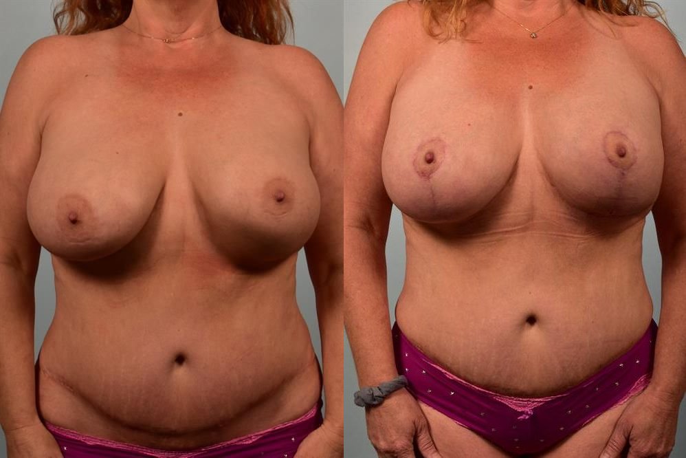 Breast Lift (Mastopexy) 25