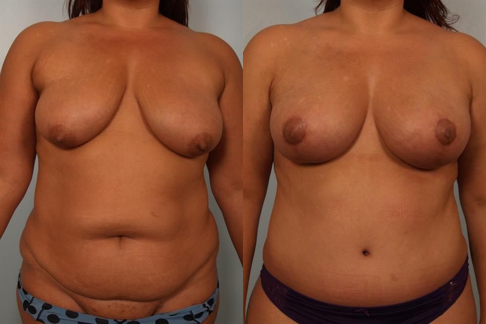 Breast Lift (Mastopexy) 26