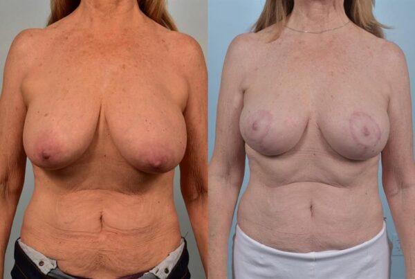 Breast Lift (Mastopexy) 27
