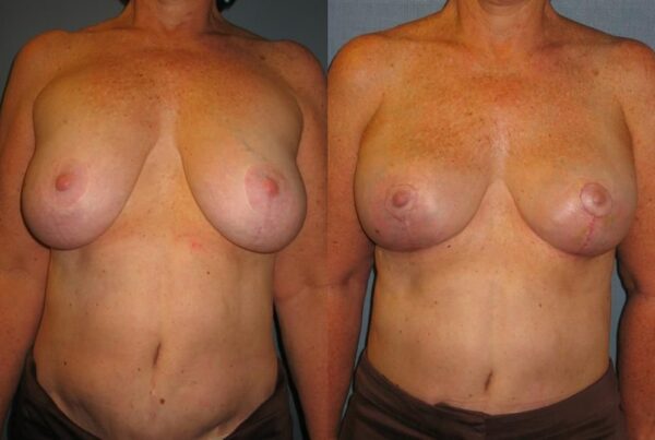 Breast Lift (Mastopexy) 28