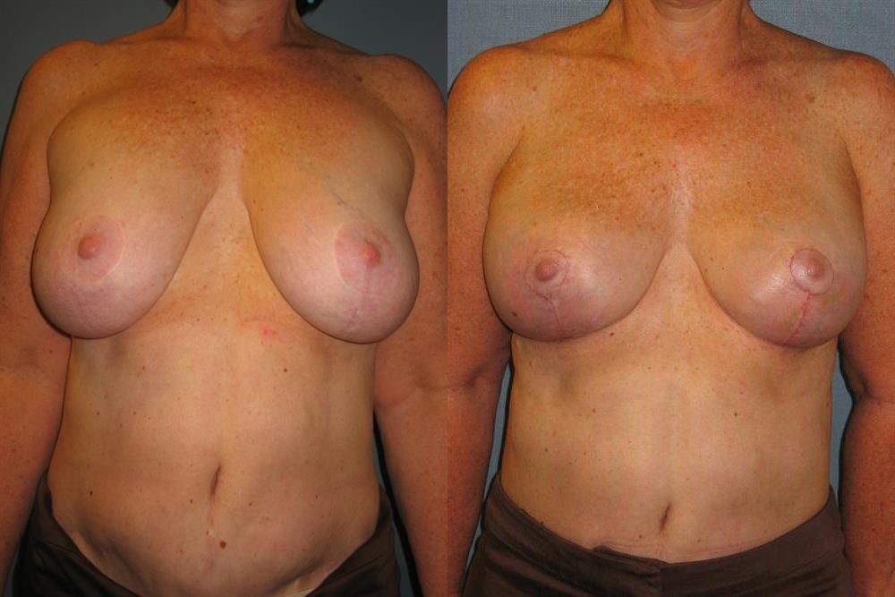 Breast Lift (Mastopexy) 28