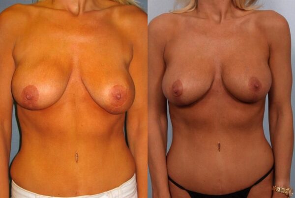 Breast Lift (Mastopexy) 29