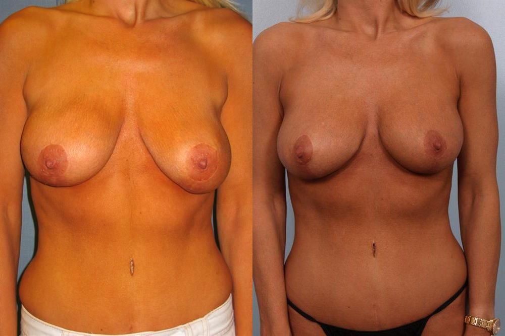 Breast Lift (Mastopexy) 29