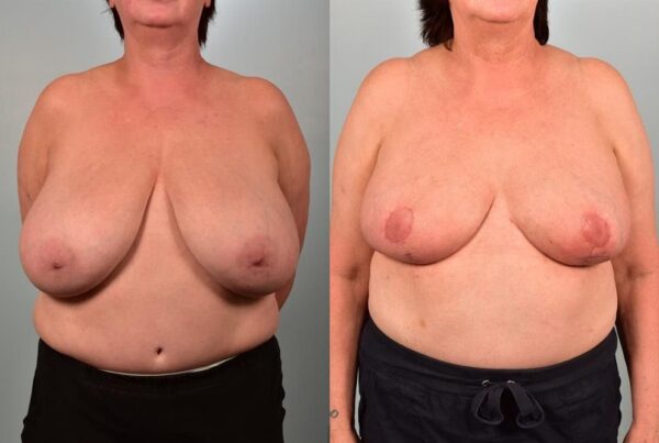Breast Lift (Mastopexy) 3