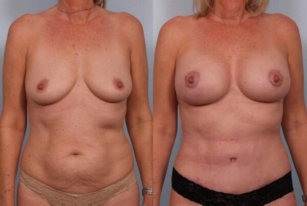 Breast Lift (Mastopexy) 30