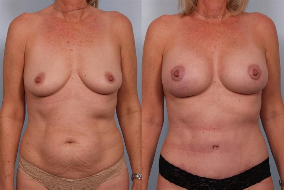Breast Lift (Mastopexy) 30