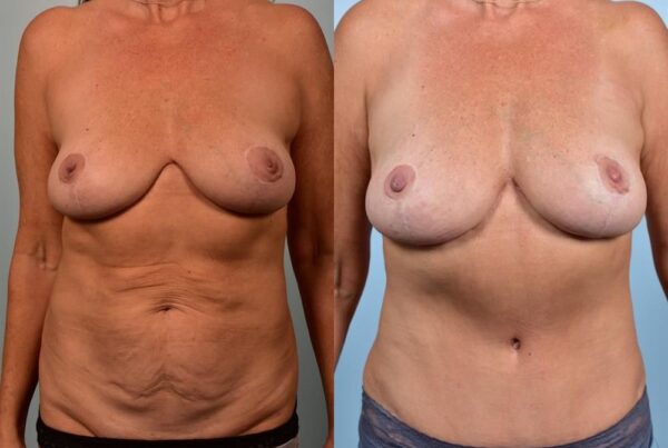 Breast Lift (Mastopexy) 31