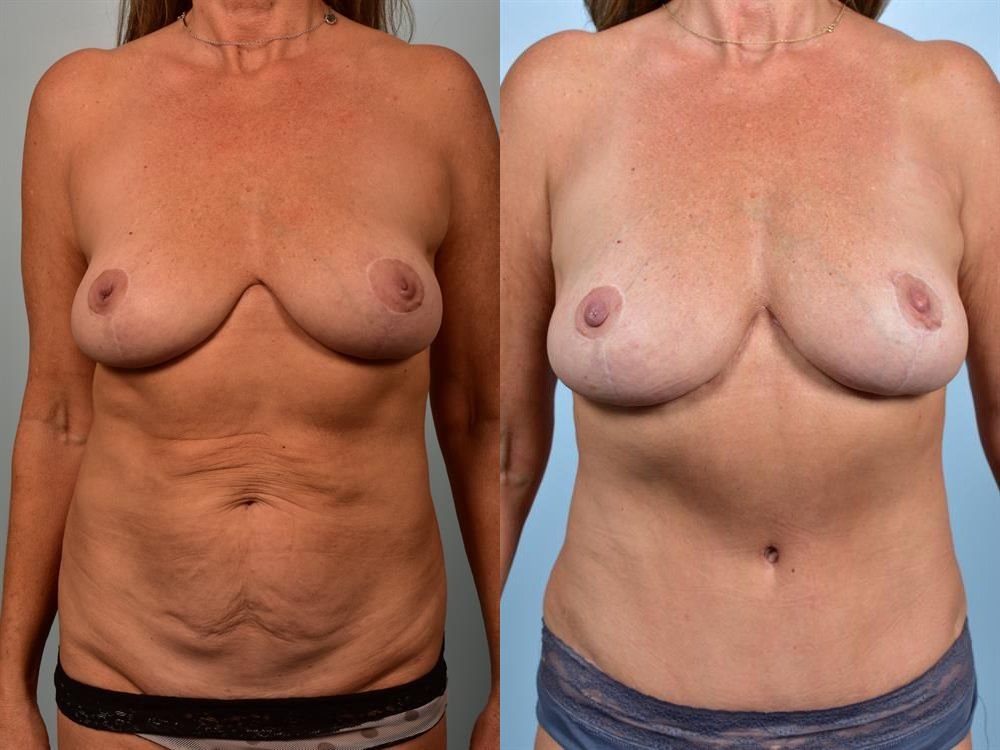 Breast Lift (Mastopexy) 31