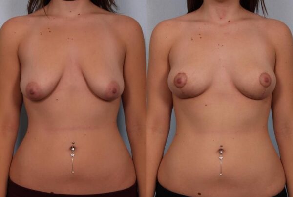 Breast Lift (Mastopexy) 32