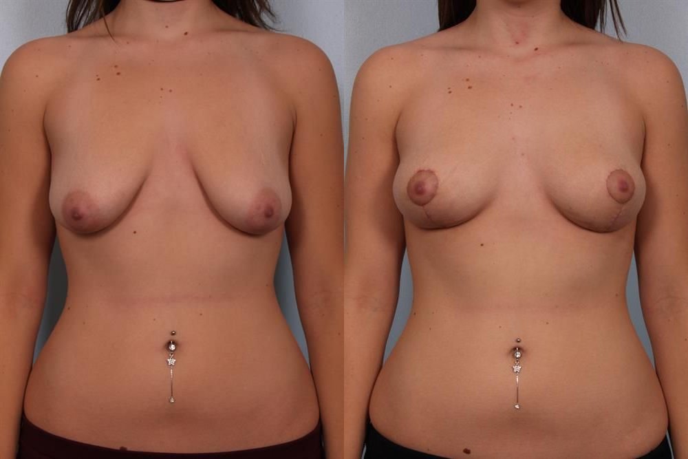 Breast Lift (Mastopexy) 32