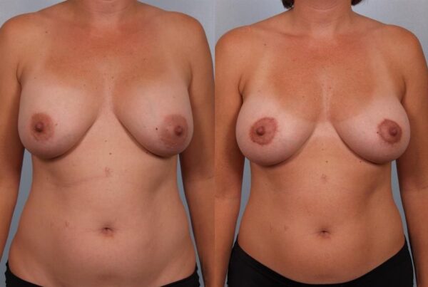 Breast Lift (Mastopexy) 33