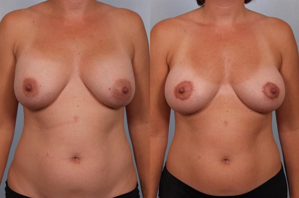 Breast Lift (Mastopexy) 33
