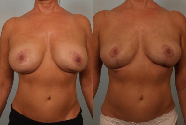 Breast Lift (Mastopexy) 34