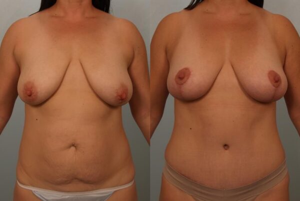 Breast Lift (Mastopexy) 35