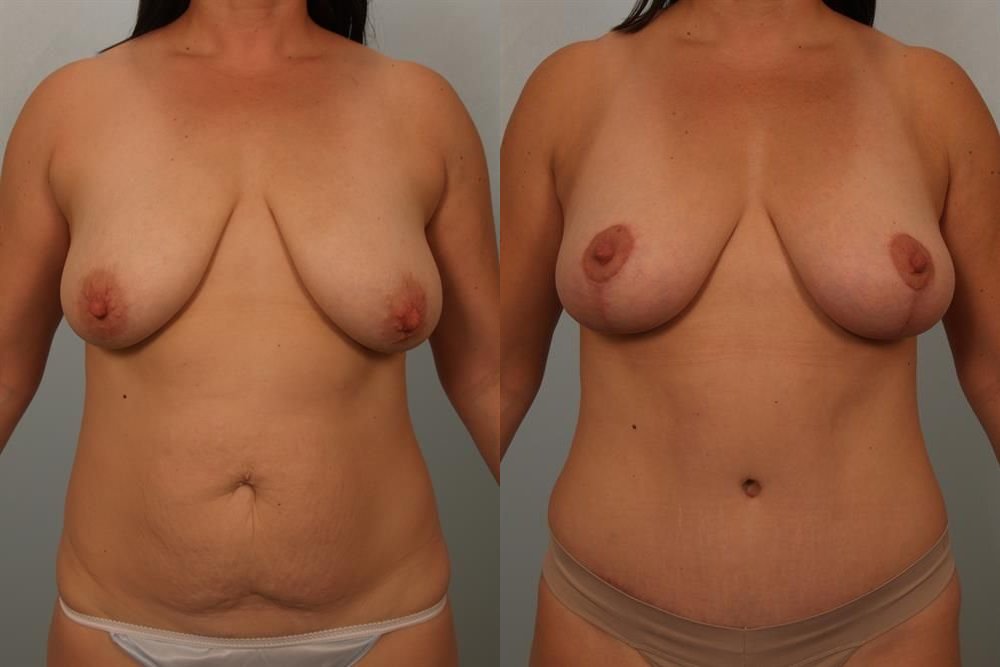 Breast Lift (Mastopexy) 35