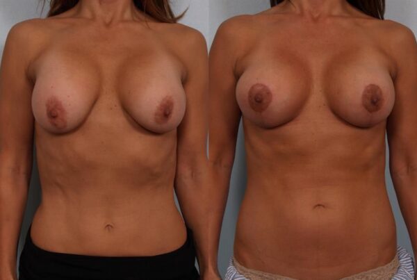 Breast Lift (Mastopexy) 36