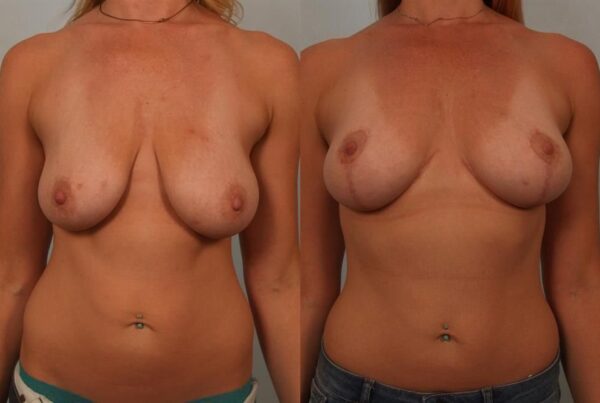 Breast Lift (Mastopexy) 37
