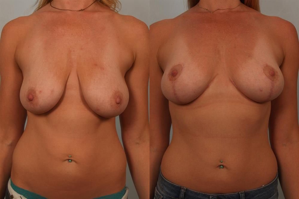 Breast Lift (Mastopexy) 37