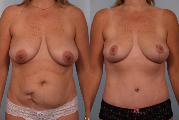Breast Lift (Mastopexy) 38