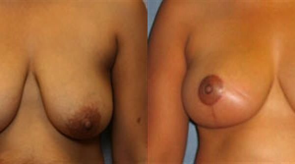 Breast Lift (Mastopexy) 39