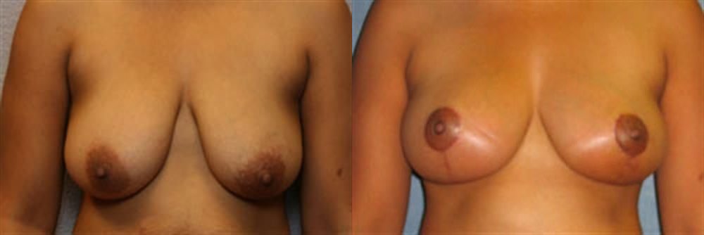 Breast Lift (Mastopexy) 39