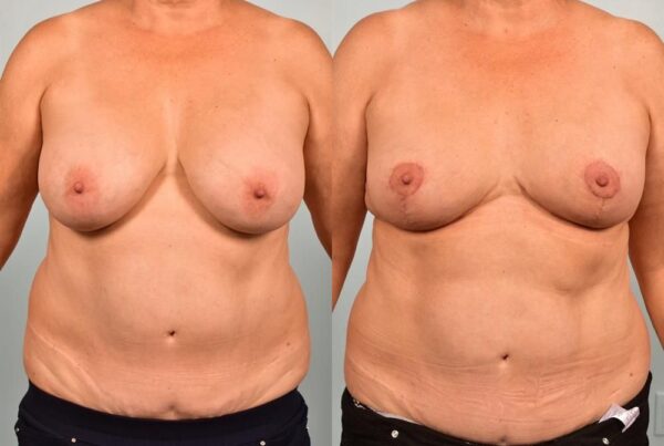 Breast Lift (Mastopexy) 40