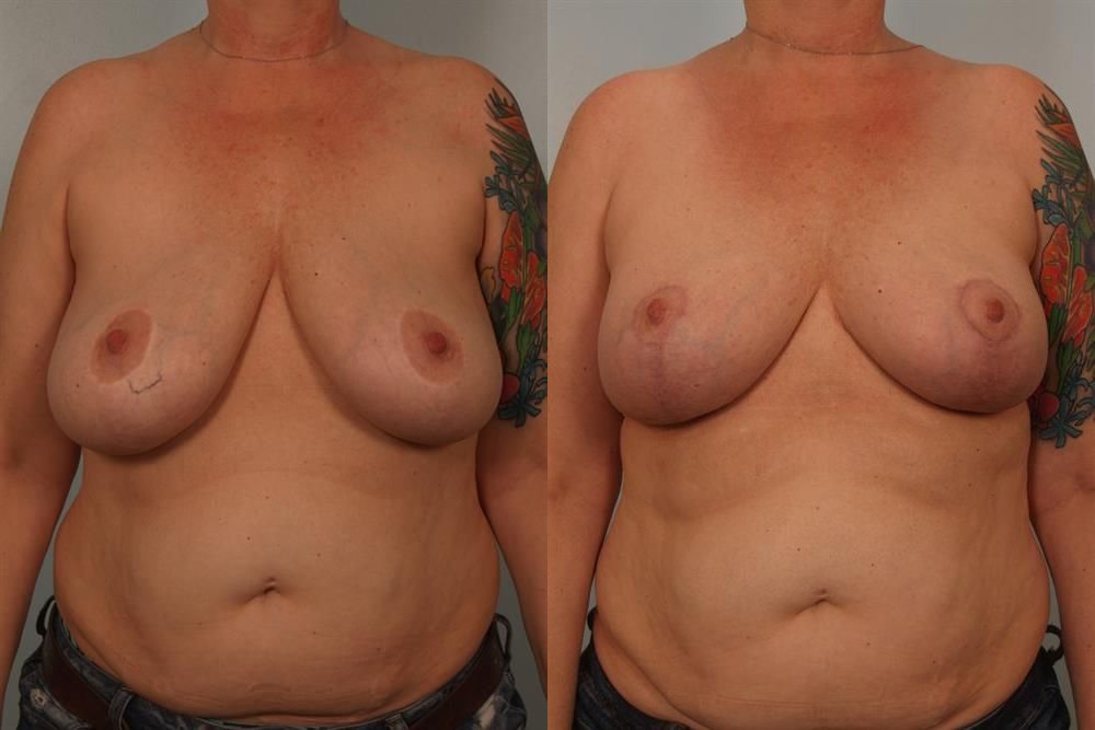 Breast Lift (Mastopexy) 41