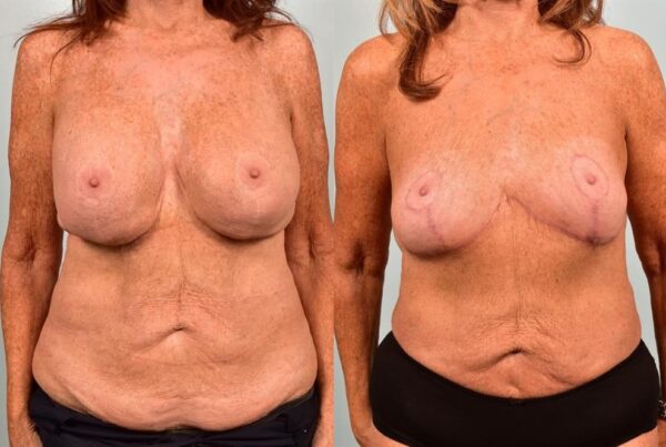 Breast Lift (Mastopexy) 42