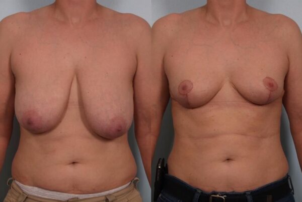 Breast Lift (Mastopexy) 43