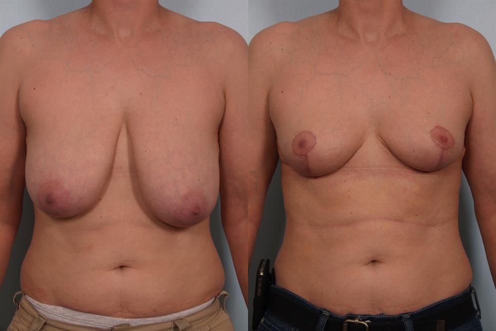 Breast Lift (Mastopexy) 43