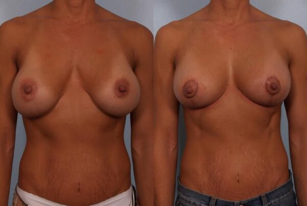 Breast Lift (Mastopexy) 44