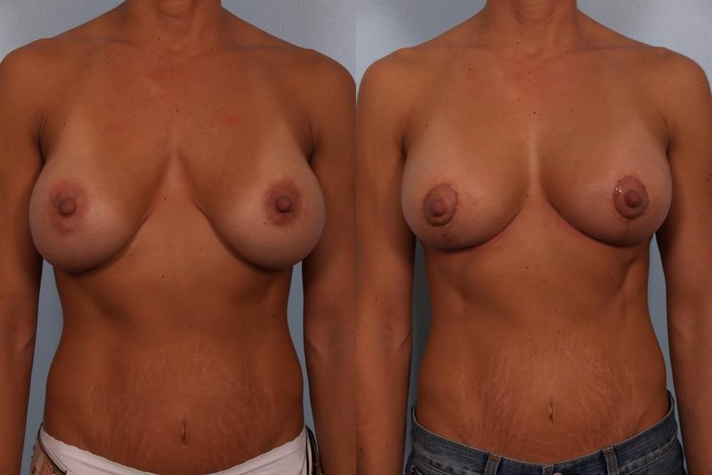 Breast Lift (Mastopexy) 44