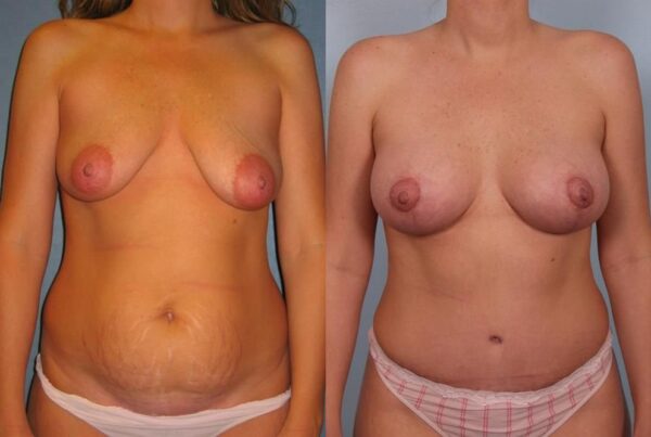 Breast Lift (Mastopexy) 46
