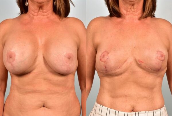 Breast Lift (Mastopexy) 47