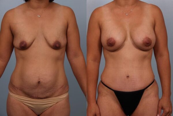 Breast Lift (Mastopexy) 48