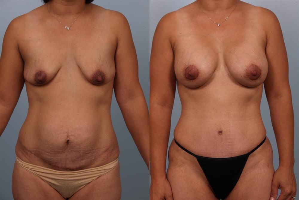 Breast Lift (Mastopexy) 48