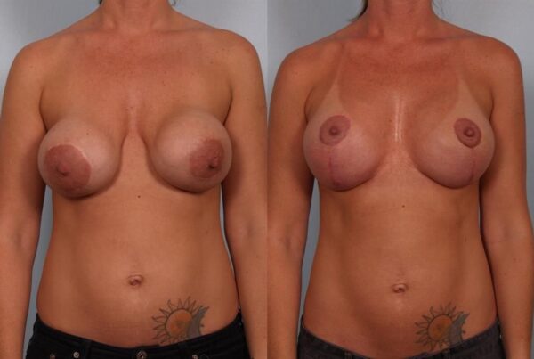 Breast Lift (Mastopexy) 49