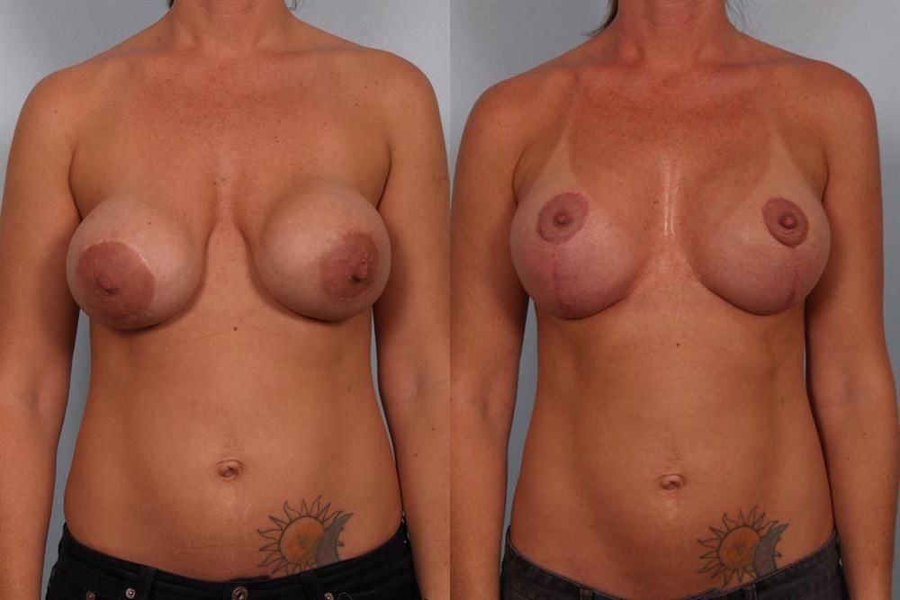 Breast Lift (Mastopexy) 49