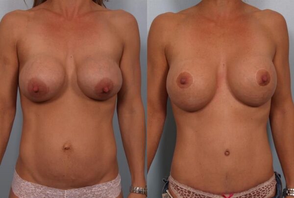 Breast Lift (Mastopexy) 5